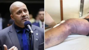 STF autoriza saídas temporárias de ex-deputado Daniel Silveira para tratamento de saúde